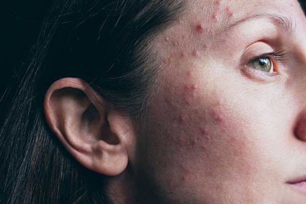 Adult female acne: Why it happens and the emotional toll